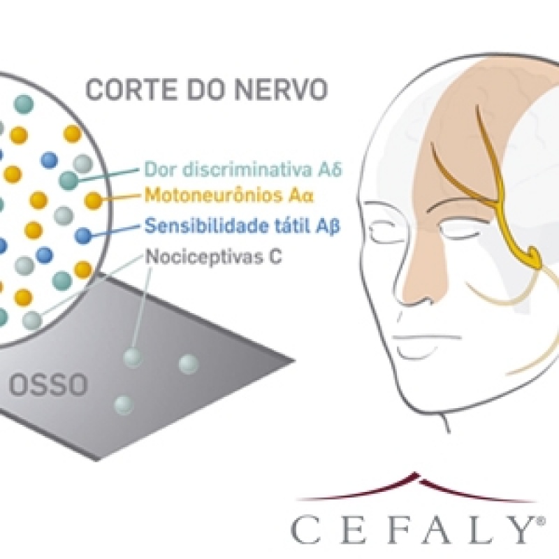 Aparelho de Neuromodulação Cefaleia Forte