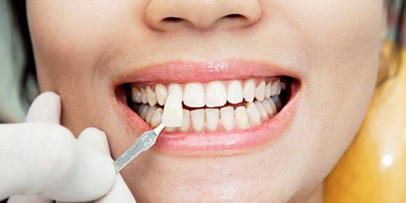 Clínica para Lentes de Contato Dental