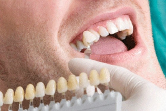 Lente de Contato para Dentes